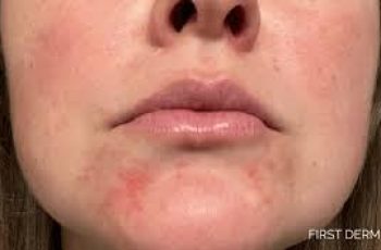 Dry Skin Around the Mouth: Causes, Prevention Tips, and Effective Treatments for Relief Dry Skin Around the Mouth: Causes, Prevention Tips, and Effective Treatments for Relief
