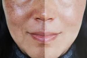 How to Treat Melasma Naturally and Get Even Skin