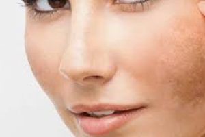 Treating Melasma From Within: Supplements, Skincare, and Lifestyle Tips