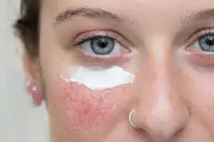 Azelaic Acid for Rosacea: A Gentle Skincare Solution Guide
