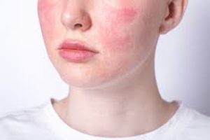 Blotchy Skin: Causes, Treatments, and Prevention for a Clear, Even Complexion