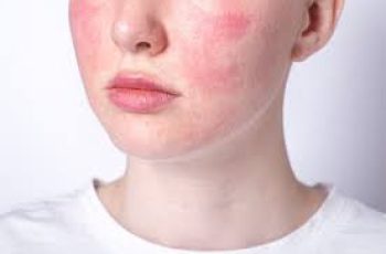 Blotchy Skin: Causes, Treatments, and Prevention for a Clear, Even Complexion