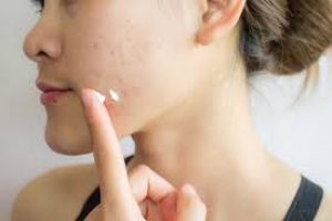 Azelaic Acid for the Long Term: Safety, Benefits, and Tips