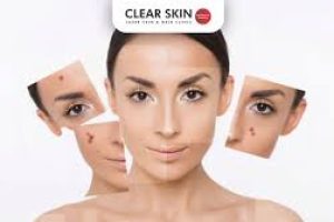 Cheek Acne Causes and Treatments: Clearer Skin With Simple Steps