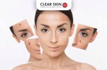 Cheek Acne Causes and Treatments: Clearer Skin With Simple Steps