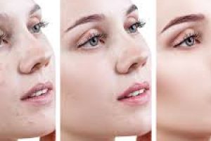 Can You Wear Makeup with Acne-Prone Skin?