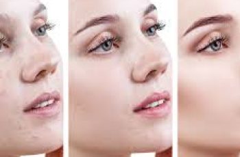 Can You Wear Makeup with Acne-Prone Skin? Can You Wear Makeup with Acne-Prone Skin?