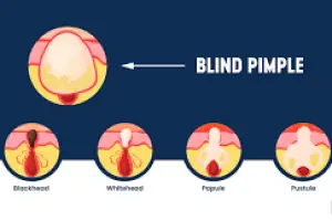 Blind Pimples: Causes, Treatments, and Prevention for Clearer Skin