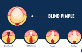 Blind Pimples: Causes, Treatments, and Prevention for Clearer Skin