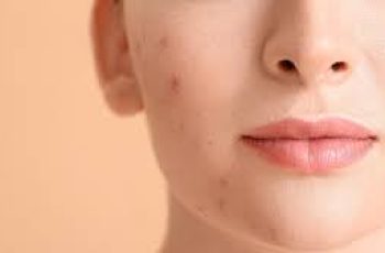Skincare Essentials: How Spot Treatments Fight Stubborn Breakouts