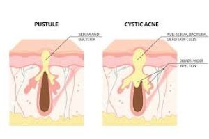 Cystic Acne Explained: Causes, Symptoms, Treatments, and Skincare Solutions