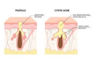 Cystic Acne Explained: Causes, Symptoms, Treatments, and Skincare Solutions Cystic Acne Explained: Causes, Symptoms, Treatments, and Skincare Solutions