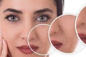 Which Dry Skin Type Are You? Learn and Treat It