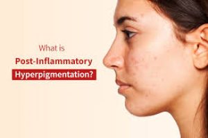 How Inflammation Triggers Hyperpigmentation—and What to Do About It