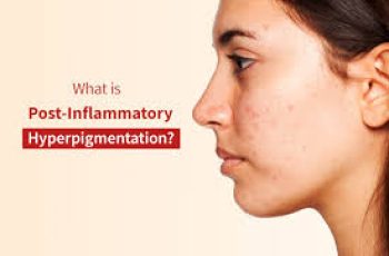 How Inflammation Triggers Hyperpigmentation—and What to Do About It How Inflammation Triggers Hyperpigmentation—and What to Do About It