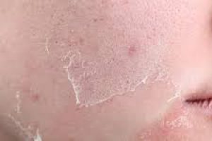 Exfoliation vs. Desquamation: How Skin Naturally Renews Itself