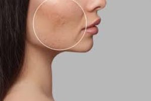 Fillers for Acne Scars: What You Need to Know