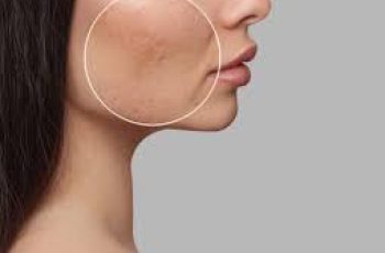 Fillers for Acne Scars: What You Need to Know