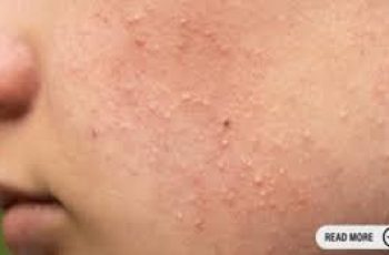Fungal Acne: The Hidden Culprit Behind Stubborn Breakouts