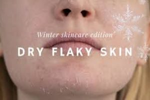 How to Get Rid of Dry Skin Fast This Winter