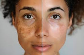 How to Fade Melasma Naturally: Your Complete Skin Care Guide How to Fade Melasma Naturally: Your Complete Skin Care Guide