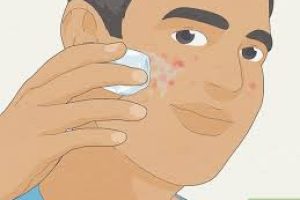 How to Get Rid of Pimples Fast: Science-Backed Tips for Clearer Skin