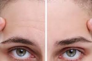 How to Reduce Forehead Wrinkles: Skincare, Lifestyle, and Botox Tips