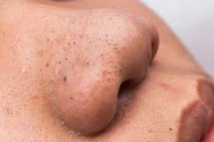 How to Remove Blackheads on Your Nose Safely and Effectively