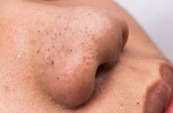 How to Remove Blackheads on Your Nose Safely and Effectively