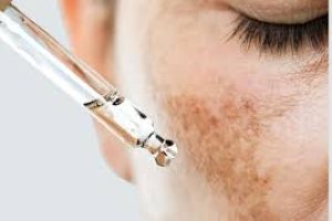 How to Fade Melasma Internally for Clearer Skin