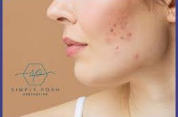 Say Goodbye to Blind Pimples: Expert Tips for Clearer Skin