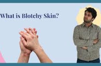 Blotchy Skin: What Causes It and How to Restore a Clear, Even Complexion
