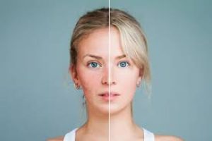 The Truth About Clearing Acne: How Long Until You See Results?