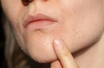 Skincare Solutions for Dry Skin Around the Mouth Area Skincare Solutions for Dry Skin Around the Mouth Area