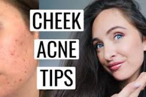 How to Get Rid of Cheek Acne at Home