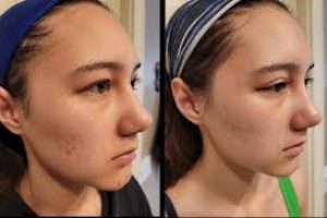 How Soon Can You Use Salicylic Acid After Microdermabrasion?