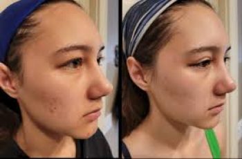 How Soon Can You Use Salicylic Acid After Microdermabrasion? How Soon Can You Use Salicylic Acid After Microdermabrasion?