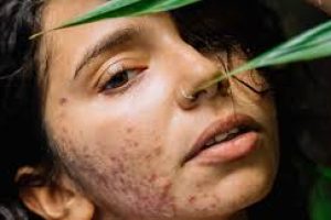 A Complete Guide to Cystic Acne Causes and Treatments