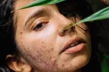 A Complete Guide to Cystic Acne Causes and Treatments
