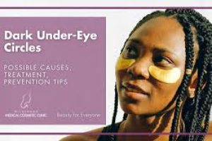 Dark Circles Under Eyes: Causes, Treatments, and Prevention Strategies