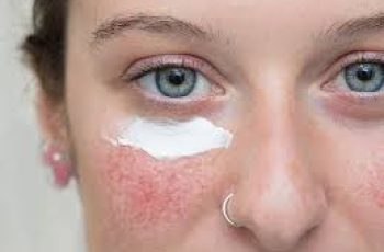 Sensitive Skin? Expert Rosacea Treatments and Skincare Explained Sensitive Skin? Expert Rosacea Treatments and Skincare Explained