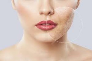 Does Makeup Cause Acne? Here’s How to Prevent Breakouts