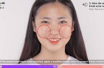 What to Put on Your Face After Acne Extractions What to Put on Your Face After Acne Extractions