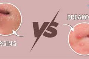 Lactic Acid and Skin Purging: Understanding the Breakouts and Benefits