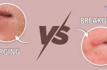 Lactic Acid and Skin Purging: Understanding the Breakouts and Benefits