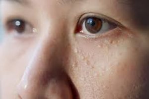 Natural Skincare Guide to Remove Milia and Smooth Your Skin