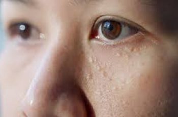 Natural Skincare Guide to Remove Milia and Smooth Your Skin