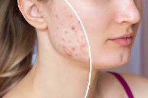 How to Clear Pimples Fast with Proven Skincare Methods
