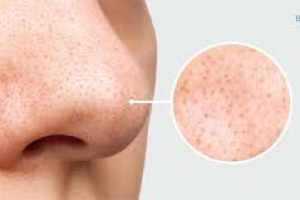 Effective Skincare Tips to Remove and Prevent Nose Blackheads