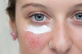 How to Use Azelaic Acid Safely for Rosacea-Prone Skin
